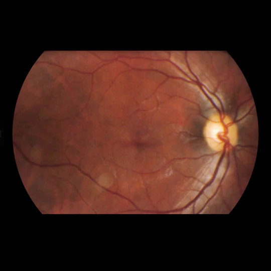 Volk Viva Fundus Camera Eye