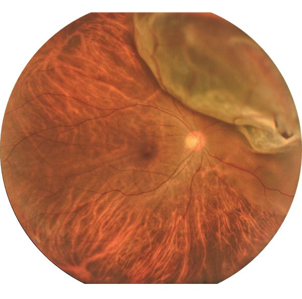 Retinal Detachment