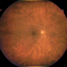 Post Cataract Surgery