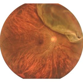 Retinal Detachment