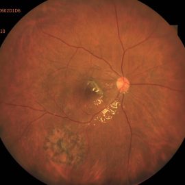 Retinal Lesion